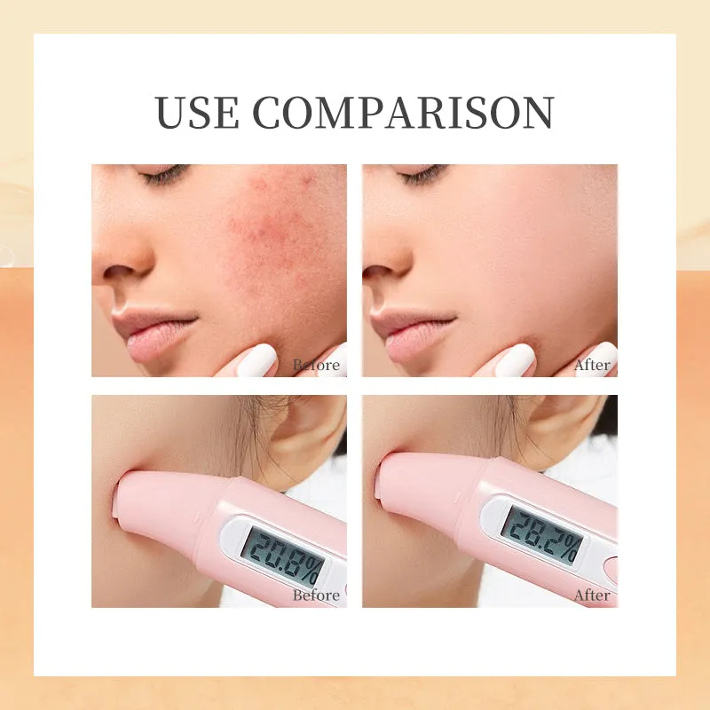 Moisturizing Anti-Acne Daily Cream Cleanser with Amino Acids - Hydrating Makeup Remover